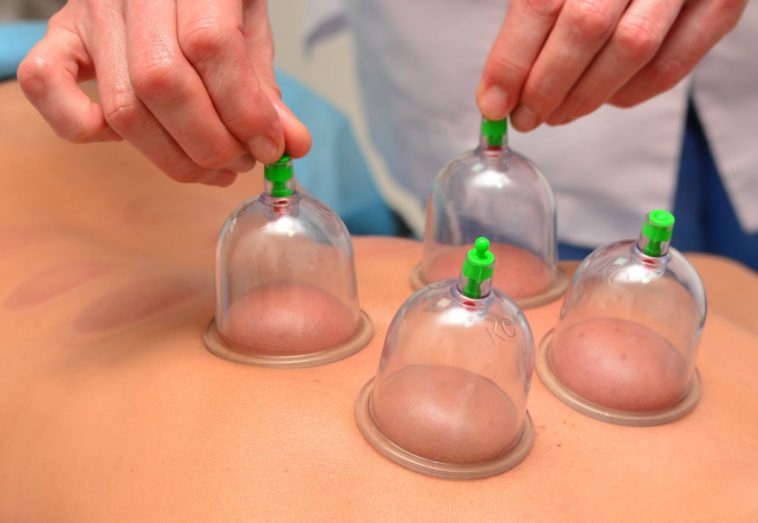http://www.clinic-eight.com/benefits-cupping-therapy/